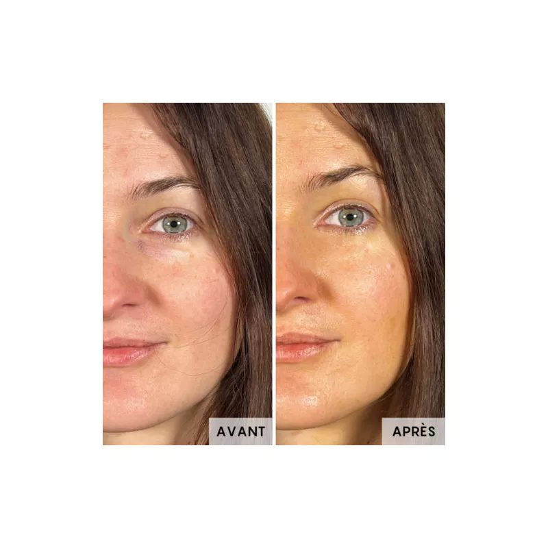 serum anti rides