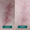 patch cicatrice
