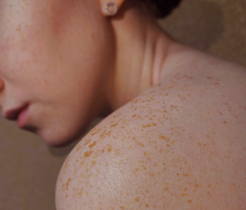 Les différences entre peau mixte, peau grasse ou peau à imperfections et leurs soins